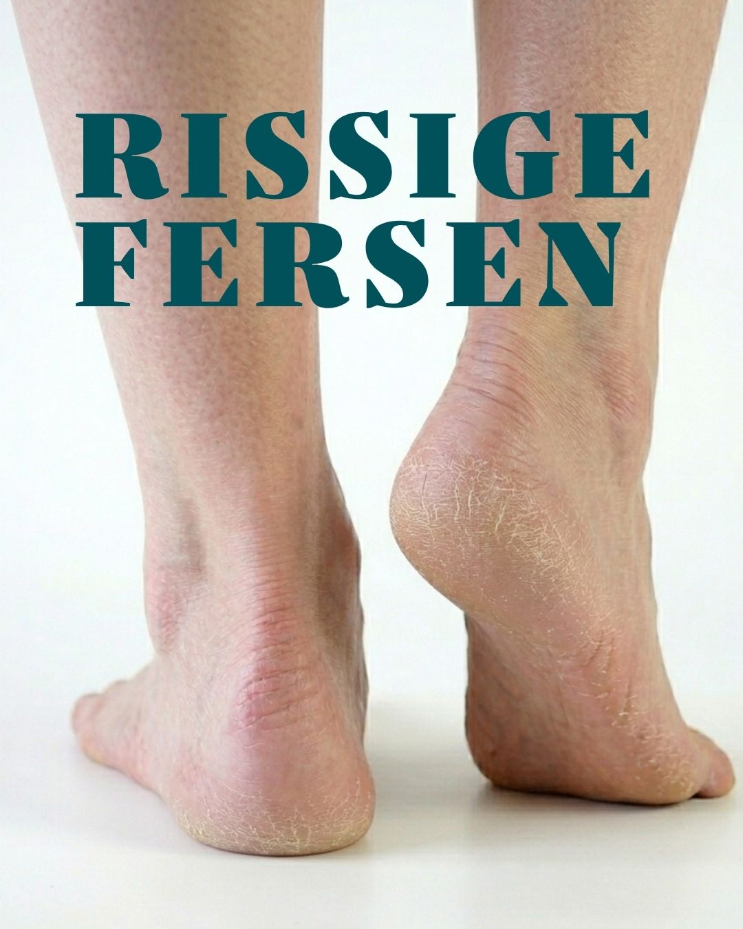 Rissige Fersen, trockene Füße: Was wirklich hilft – und was nicht