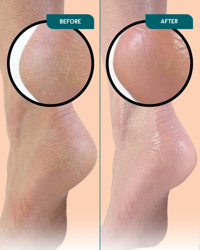 Foot Care Set – 3 Steps for Cracked Heels